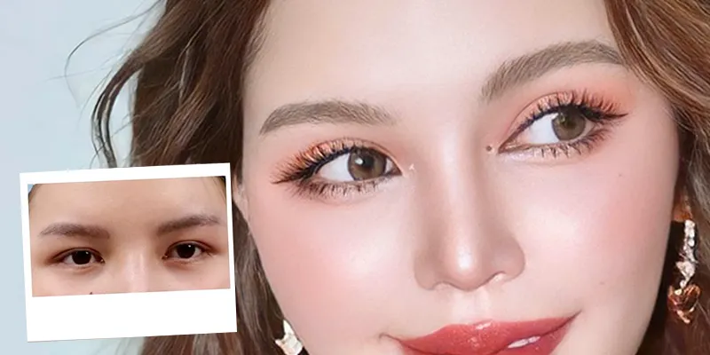 Cắt mí rồi có cắt lại được không?