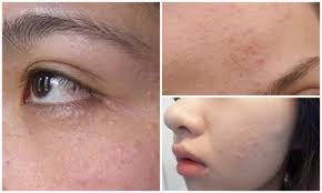 Điều trị mụn ẩn