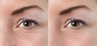 Xóa nhăn bằng công nghệ cao